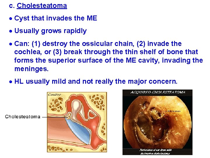 c. Cholesteatoma Cyst that invades the ME Usually grows rapidly Can: (1) destroy the