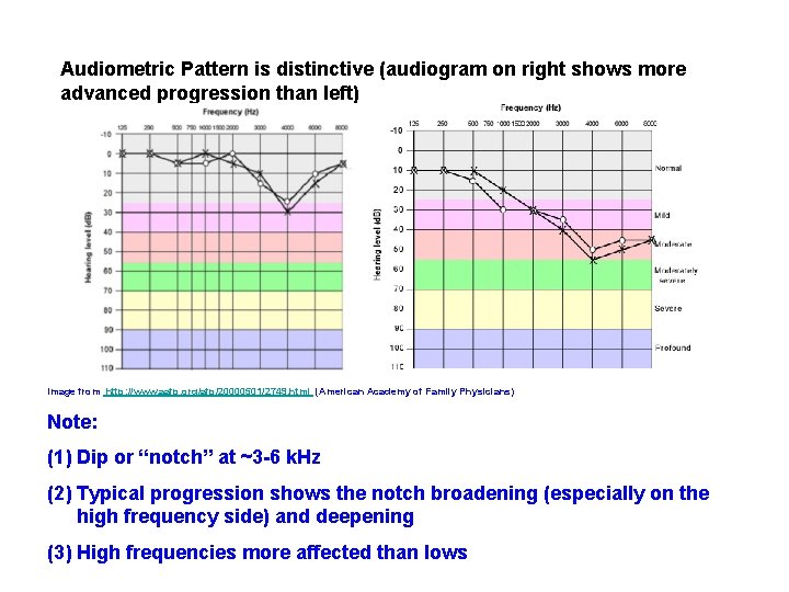 Audiometric Pattern is distinctive (audiogram on right shows more advanced progression than left) Image