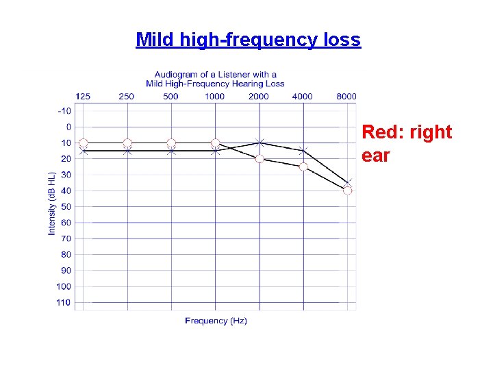Mild high-frequency loss Red: right ear Mild high-frequency loss Red: right ear