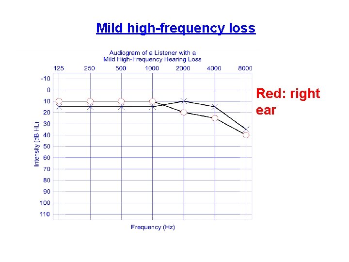 Mild high-frequency loss Red: right ear 