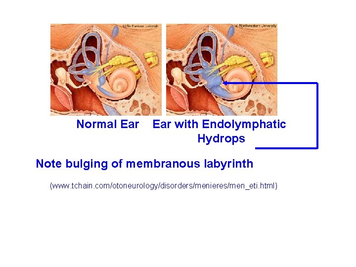 Normal Ear with Endolymphatic Hydrops Note bulging of membranous labyrinth (www. tchain. com/otoneurology/disorders/menieres/men_eti. html) Normal Ear with Endolymphatic Hydrops Note bulging of membranous labyrinth (www. tchain. com/otoneurology/disorders/menieres/men_eti. html)