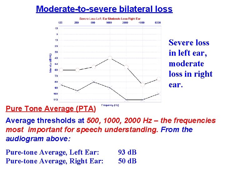 Moderate-to-severe bilateral loss Severe loss in left ear, moderate loss in right ear. Pure Moderate-to-severe bilateral loss Severe loss in left ear, moderate loss in right ear. Pure