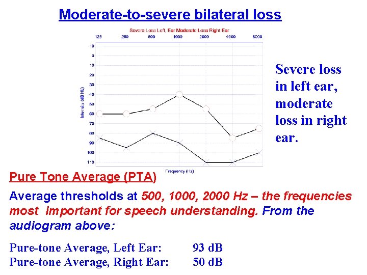 Moderate-to-severe bilateral loss Severe loss in left ear, moderate loss in right ear. Pure