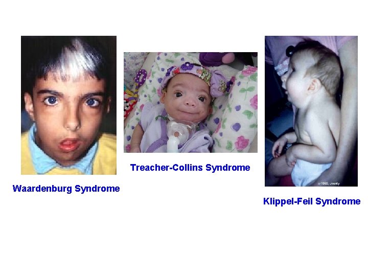 Treacher-Collins Syndrome Waardenburg Syndrome Klippel-Feil Syndrome Treacher-Collins Syndrome Waardenburg Syndrome Klippel-Feil Syndrome