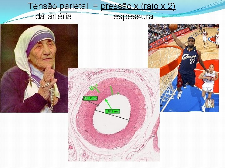Tensão parietal = pressão x (raio x 2) da artéria espessura 