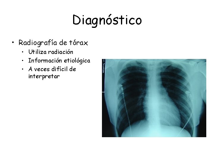 Diagnóstico • Radiografía de tórax • Utiliza radiación • Información etiológica • A veces Diagnóstico • Radiografía de tórax • Utiliza radiación • Información etiológica • A veces
