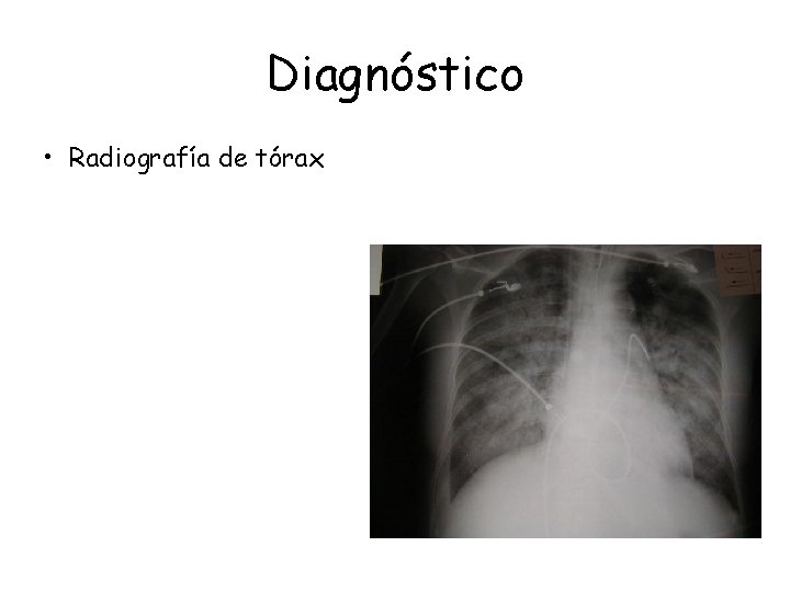 Diagnóstico • Radiografía de tórax Diagnóstico • Radiografía de tórax