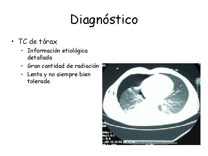 Diagnóstico • TC de tórax • Información etiológica detallada • Gran cantidad de radiación Diagnóstico • TC de tórax • Información etiológica detallada • Gran cantidad de radiación