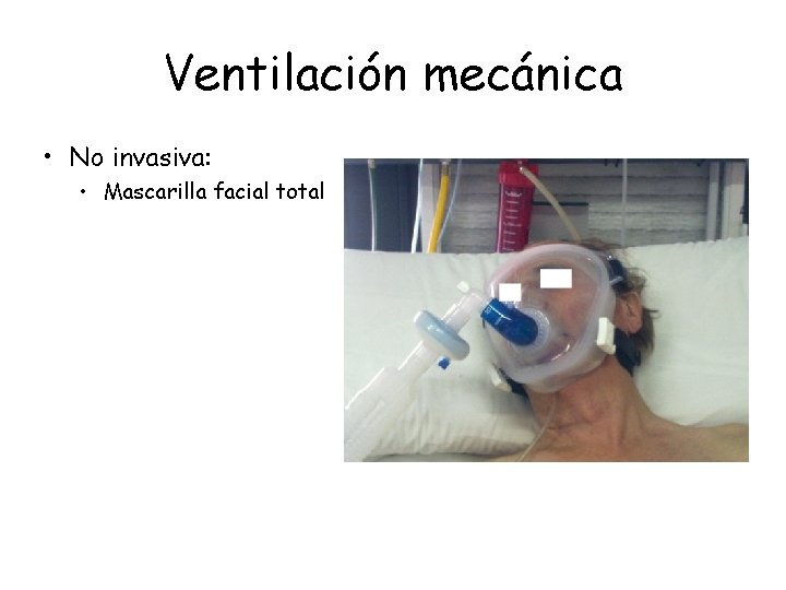 Ventilación mecánica • No invasiva: • Mascarilla facial total Ventilación mecánica • No invasiva: • Mascarilla facial total