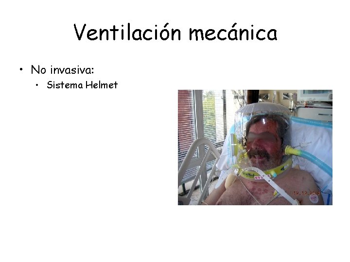 Ventilación mecánica • No invasiva: • Sistema Helmet Ventilación mecánica • No invasiva: • Sistema Helmet