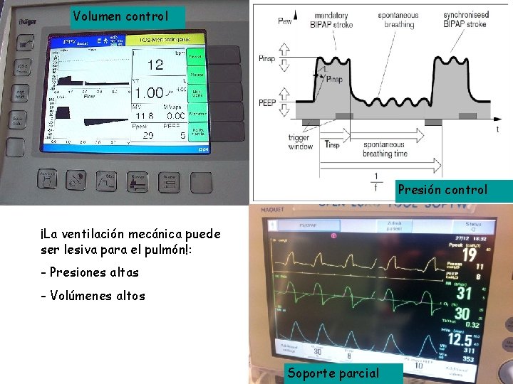 Volumen control Presión control ¡La ventilación mecánica puede ser lesiva para el pulmón!: - Volumen control Presión control ¡La ventilación mecánica puede ser lesiva para el pulmón!: -