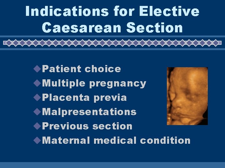 Indications for Elective Caesarean Section u. Patient choice u. Multiple pregnancy u. Placenta previa Indications for Elective Caesarean Section u. Patient choice u. Multiple pregnancy u. Placenta previa