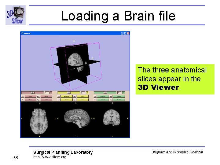 Loading a Brain file The three anatomical slices appear in the 3 D Viewer.