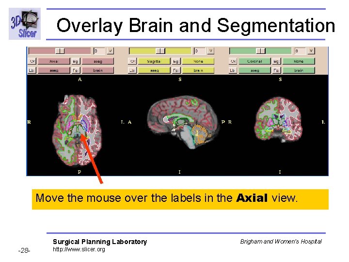 Overlay Brain and Segmentation Move the mouse over the labels in the Axial view.