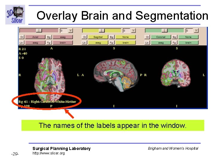 Overlay Brain and Segmentation The names of the labels appear in the window. Surgical