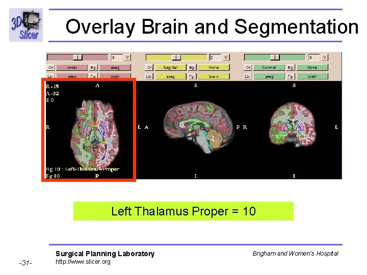 Overlay Brain and Segmentation Left Thalamus Proper = 10 Surgical Planning Laboratory -31 -