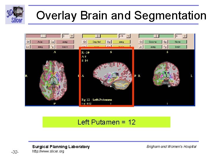 Overlay Brain and Segmentation Left Putamen = 12 Surgical Planning Laboratory -32 - http: