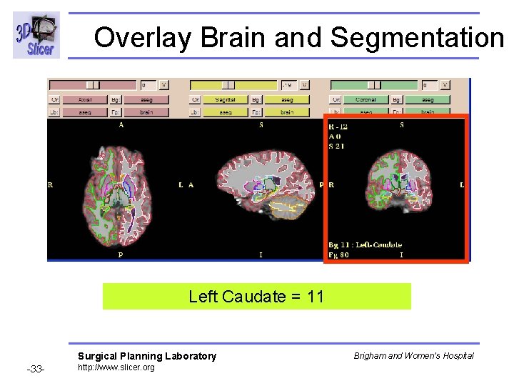 Overlay Brain and Segmentation Left Caudate = 11 Surgical Planning Laboratory -33 - http: