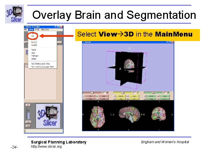 Overlay Brain and Segmentation Select View 3 D in the Main. Menu Surgical Planning