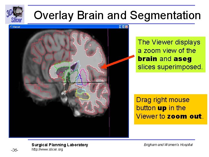 Overlay Brain and Segmentation The Viewer displays a zoom view of the brain and