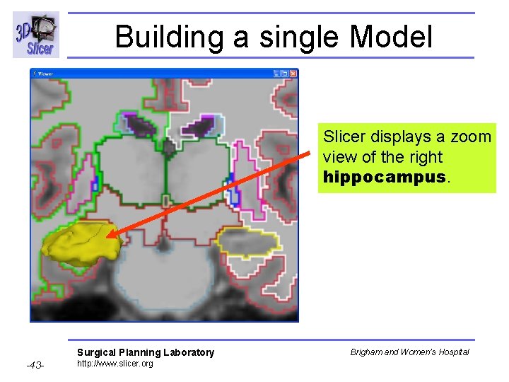 Building a single Model Slicer displays a zoom view of the right hippocampus. Surgical