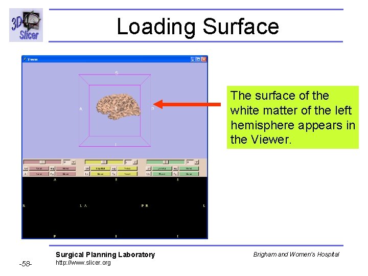 Loading Surface The surface of the white matter of the left hemisphere appears in