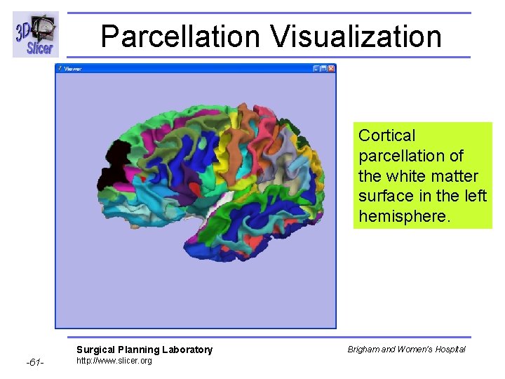 Parcellation Visualization Cortical parcellation of the white matter surface in the left hemisphere. Surgical