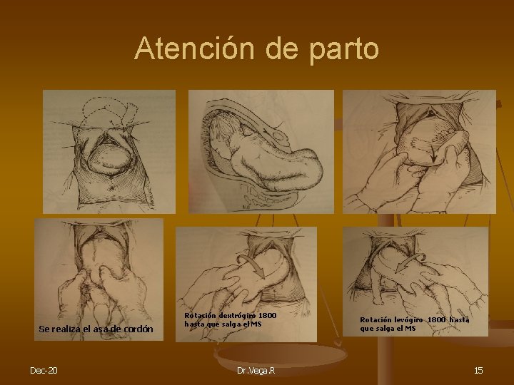 Atención de parto Se realiza el asa de cordón Dec-20 Rotación dextrógiro 1800 hasta