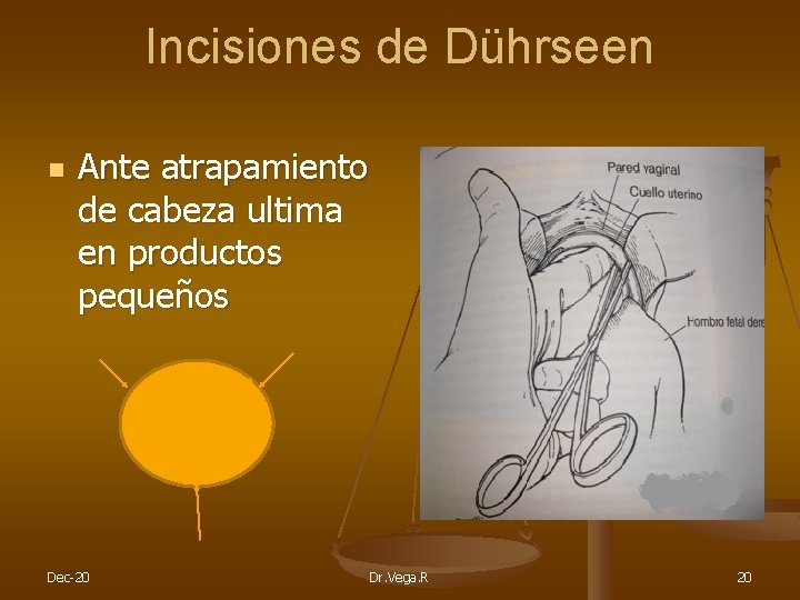 Incisiones de Dührseen n Ante atrapamiento de cabeza ultima en productos pequeños Dec-20 Dr.