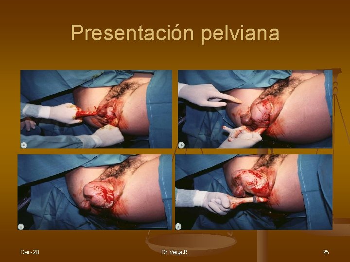 Presentación pelviana Dec-20 Dr. Vega. R 26 