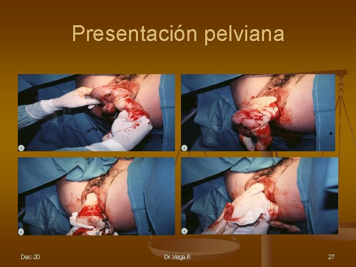 Presentación pelviana Dec-20 Dr. Vega. R 27 