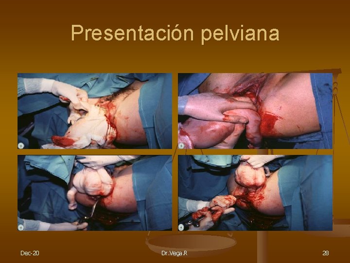 Presentación pelviana Dec-20 Dr. Vega. R 28 