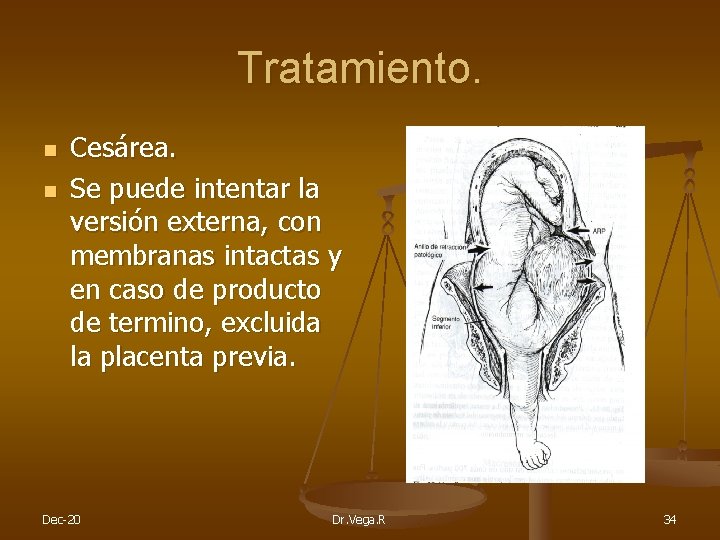 Tratamiento. n n Cesárea. Se puede intentar la versión externa, con membranas intactas y