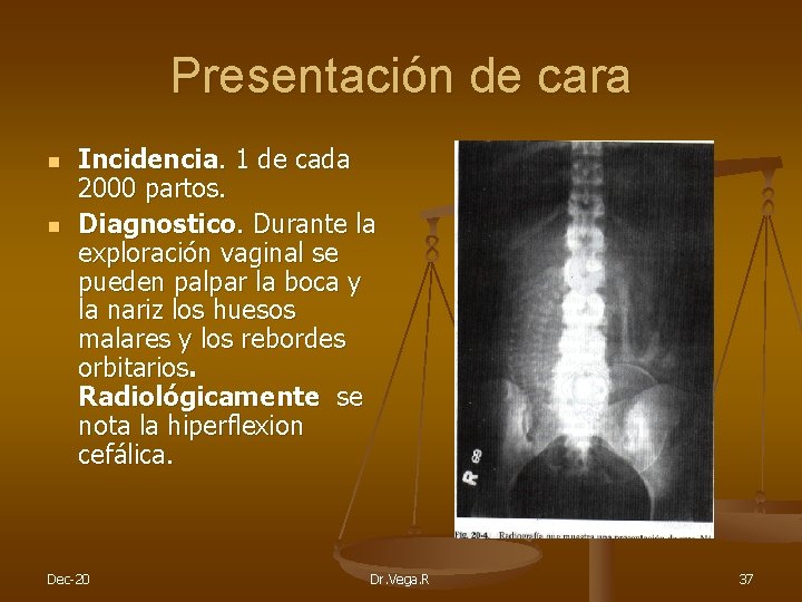 Presentación de cara n n Incidencia. 1 de cada 2000 partos. Diagnostico. Durante la