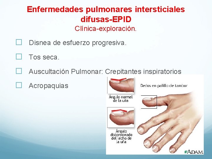 Enfermedades pulmonares intersticiales difusas-EPID Clínica-exploración. � Disnea de esfuerzo progresiva. � Tos seca. �