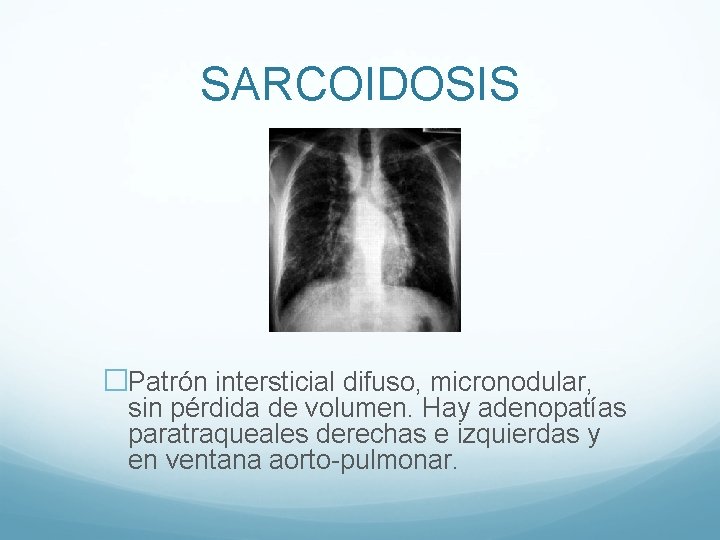 SARCOIDOSIS �Patrón intersticial difuso, micronodular, sin pérdida de volumen. Hay adenopatías paratraqueales derechas e
