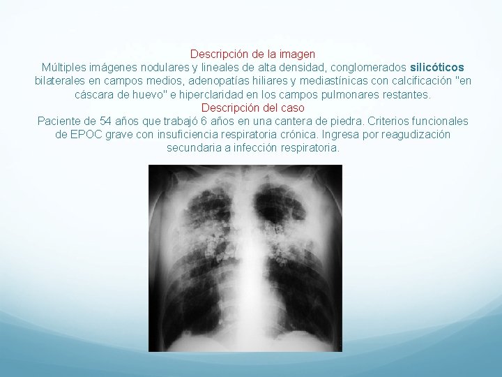 Descripción de la imagen Múltiples imágenes nodulares y lineales de alta densidad, conglomerados silicóticos