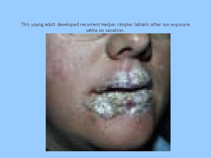 This young adult developed recurrent Herpes simples labialis after sun exposure while on vacation.