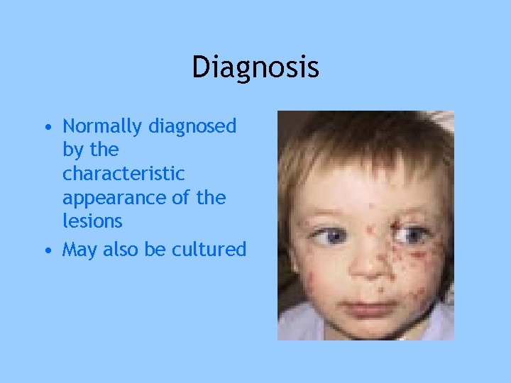 Diagnosis • Normally diagnosed by the characteristic appearance of the lesions • May also