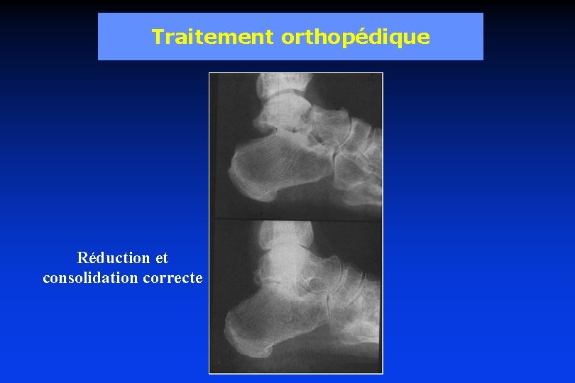 Traitement orthopédique Réduction et consolidation correcte 