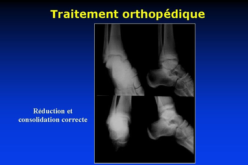 Traitement orthopédique Réduction et consolidation correcte 
