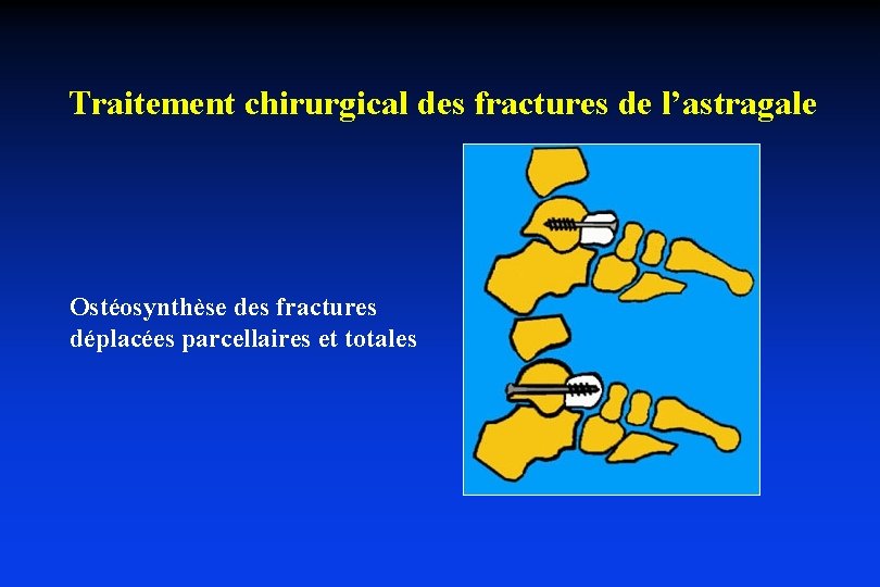 Traitement chirurgical des fractures de l’astragale Ostéosynthèse des fractures déplacées parcellaires et totales 