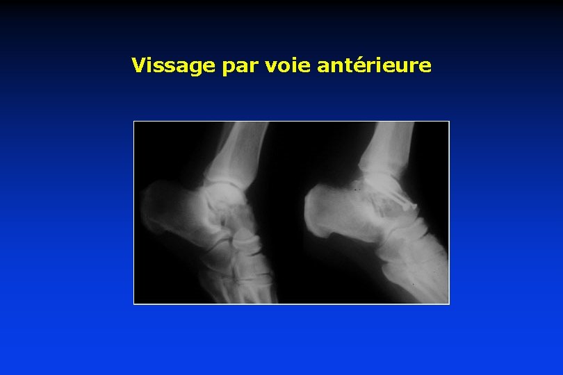 Vissage par voie antérieure 