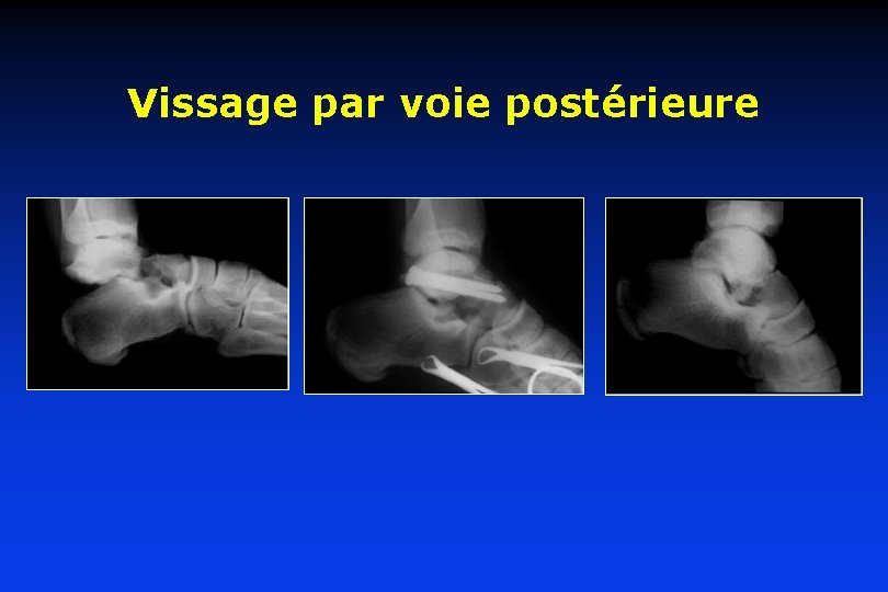Vissage par voie postérieure 
