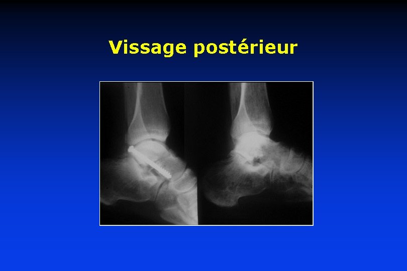 Vissage postérieur 