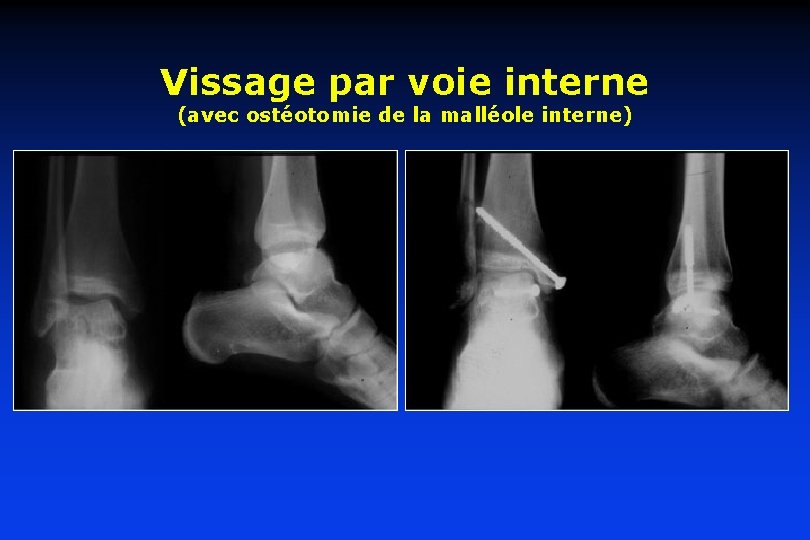 Vissage par voie interne (avec ostéotomie de la malléole interne) 