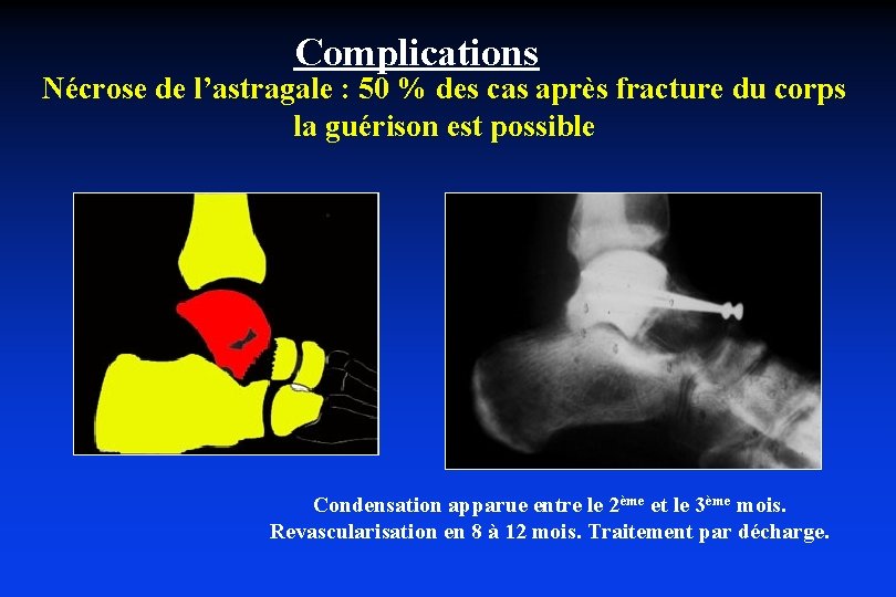 Complications Nécrose de l’astragale : 50 % des cas après fracture du corps la