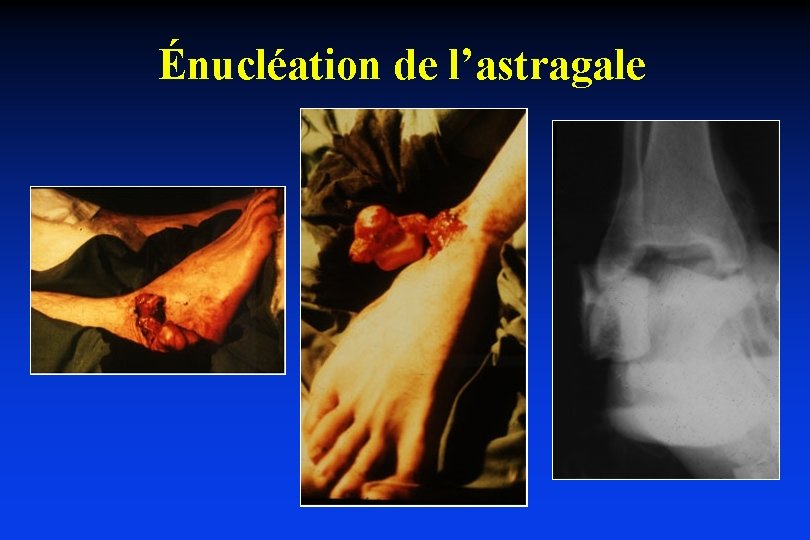 Énucléation de l’astragale 
