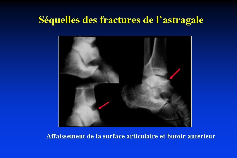 Séquelles des fractures de l’astragale Affaissement de la surface articulaire et butoir antérieur 