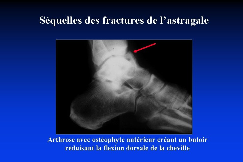 Séquelles des fractures de l’astragale Arthrose avec ostéophyte antérieur créant un butoir réduisant la